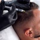 Forcells®️ Treatments - Regenerative Hair Restoration