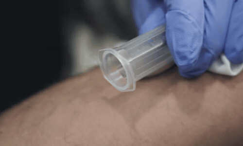 Forcells Orthobiologics: Draw Blood