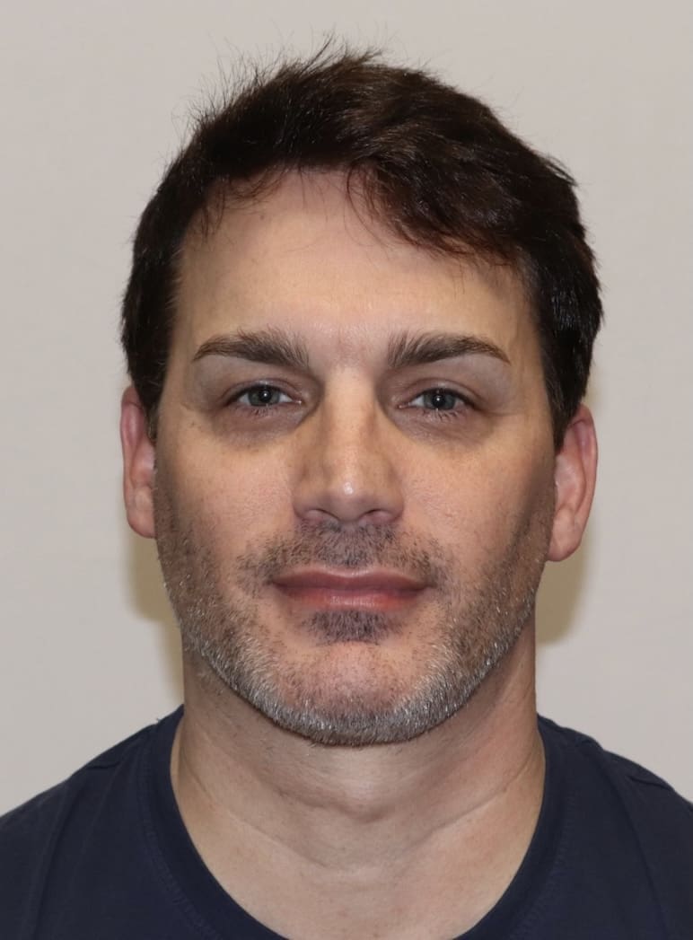 Forcells®️ Hair restoration - After Photo