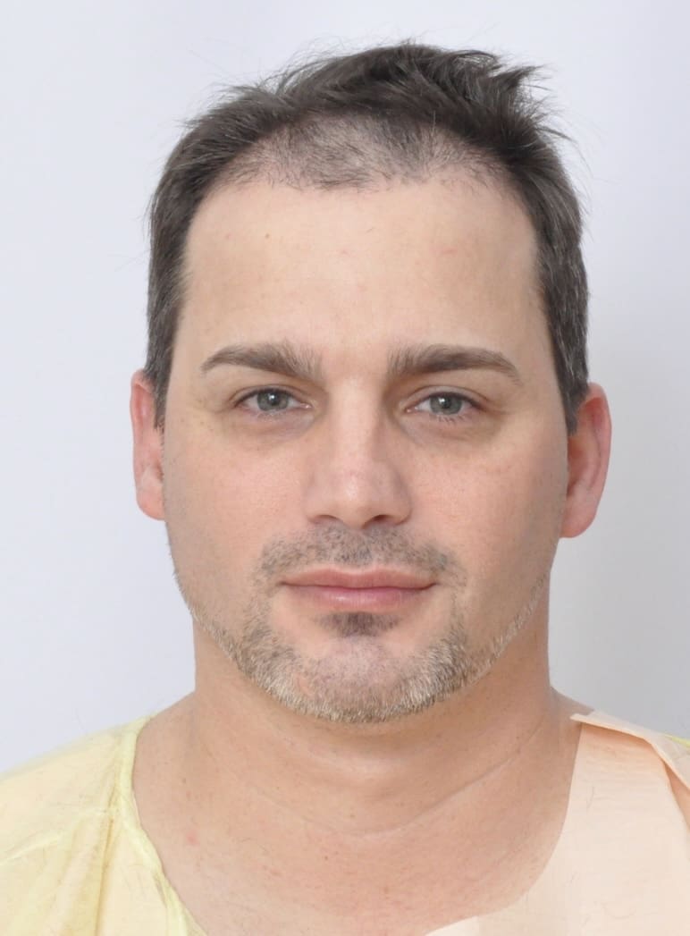Forcells®️ Hair restoration - Before Photo