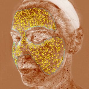 VISIA 3D - Brown Spots
