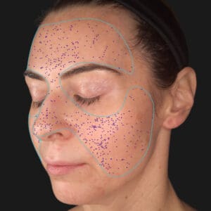 VISIA 3D - Pores