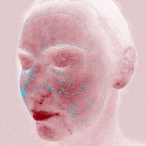 VISIA 3D - Red Areas