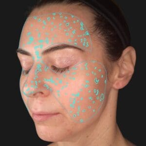 VISIA 3D - Spots