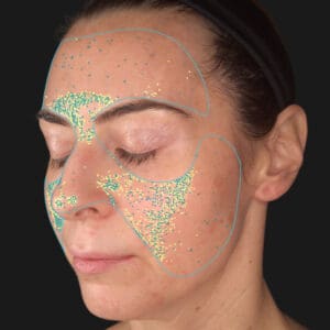 VISIA 3D - Texture