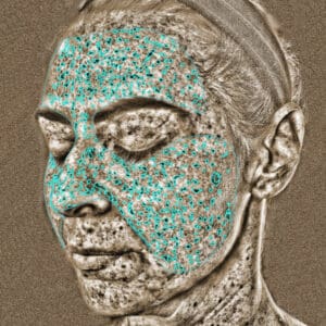 VISIA 3D - UV Spots