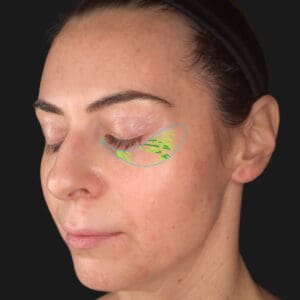 VISIA 3D - Wrinkles